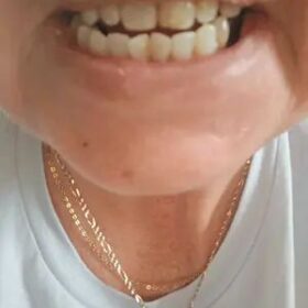 DRDENT Purple Teeth Whitening Strips - 7/21 Whitening Sessions - Safe for Enamel - Non Sensitive Teeth Whitening - Peroxide-Free photo review