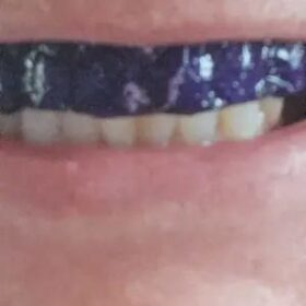 DRDENT Purple Teeth Whitening Strips - 7/21 Whitening Sessions - Safe for Enamel - Non Sensitive Teeth Whitening - Peroxide-Free photo review